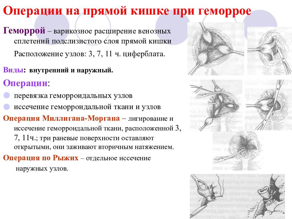 12 операций. Операция Миллигана Моргана. Перевязка геморроидальных узлов операция. Геморройные узлы операция.