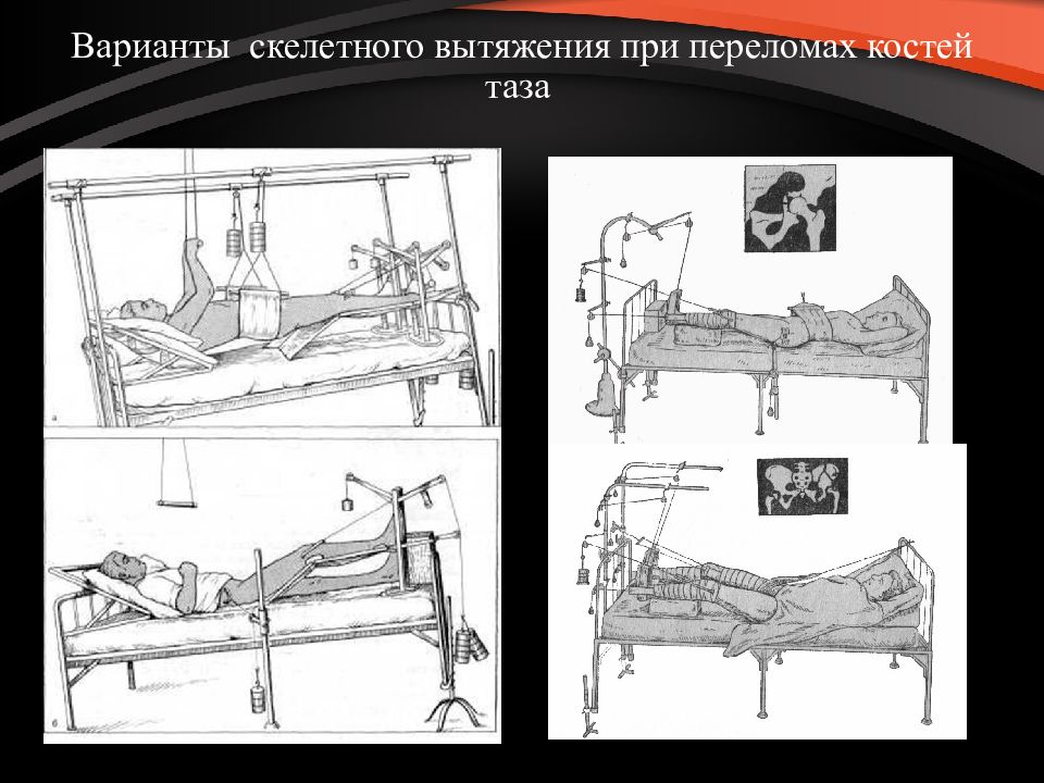 Переломы таза травматология презентация