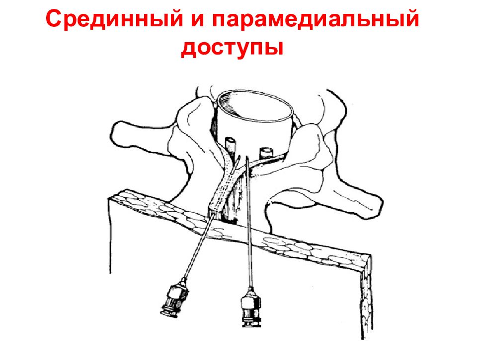 Эпидуральная блокада. Паравертебральная блокада позвоночника. Паравертебральная, эпидуральная блокада. Паравертебральная блокада в акушерстве.