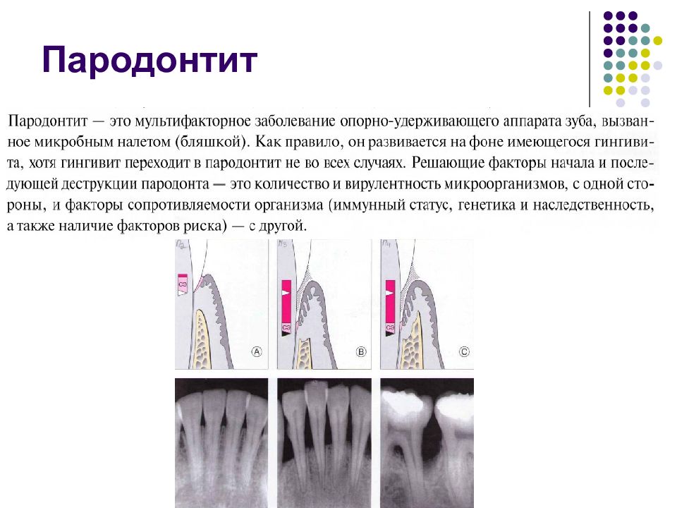 Диагностика заболеваний пародонта. Пародонтит классификация. Пародонтит характеристика. Пародонтит средней степени тяжести мкб 10. Пародонтит презентация.