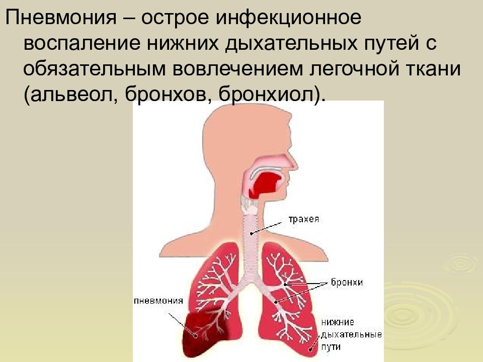 Воспаление легких это. Воспаление нижних дыхательных путей. Пневмония нижних дыхательных путей. Острые инфекции нижних дыхательных путей. Заболевания нижних дыхательных путей пневмония.