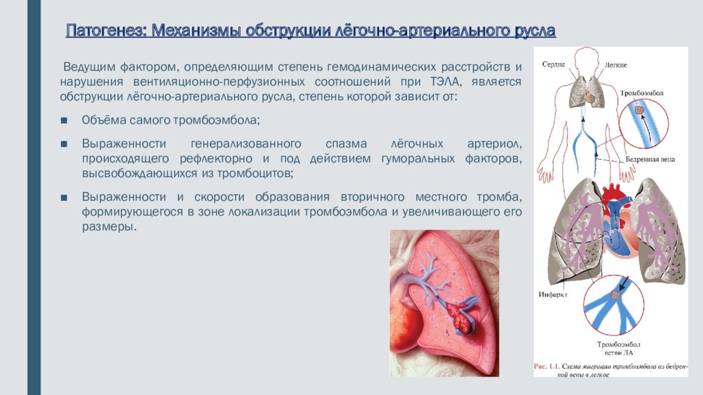 Тромбоэмболия артерии миокарда. Легочная тромбоэмболия.