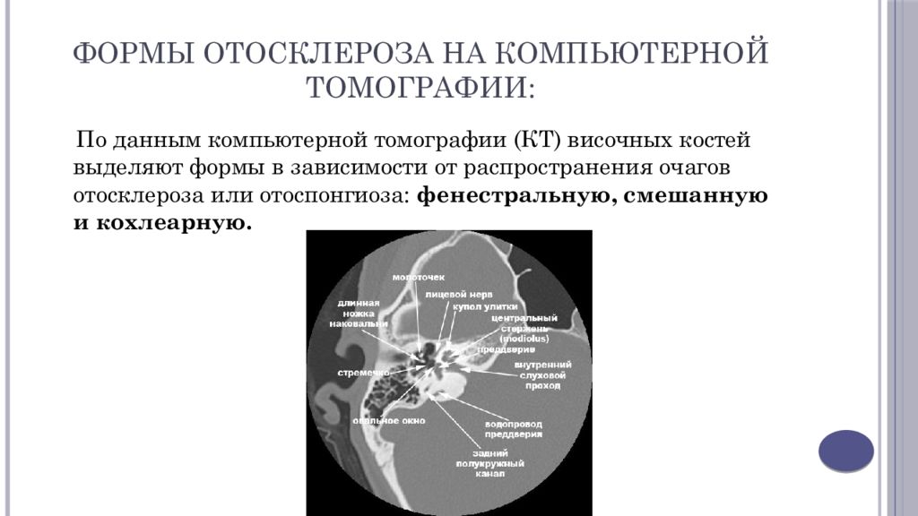 Темпоральный склероз. Кохлеарная форма отосклероза кт. Фенестральная форма отосклероза на кт. Кт височных костей при отосклерозе. Смешанная форма отосклероза кт.