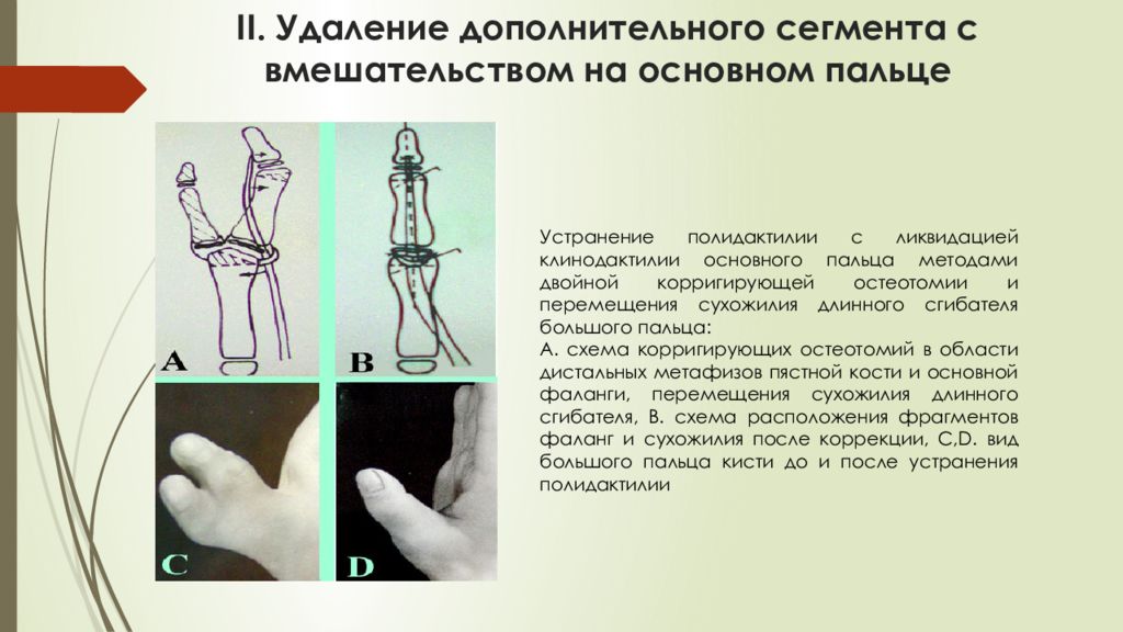 Удалил пальцы. Удаление добавочного пальца. Полидактилия классификация. Добавочный палец кисти. Полидактилия стопы рентген.