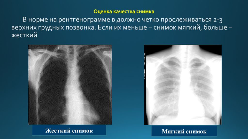 Что значит снимок. Качества оценки рентгена. Качество снимка рентгенограммы. Оценка качества рентгенограммы. Мягкое качество рентгенограммы.