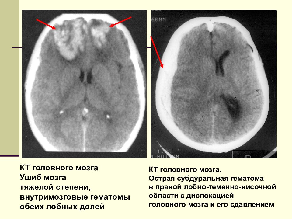Гематома в стадии организации. Ушиб головного мозга кт мрт. Острая внутримозговая гематома кт стадии. Субдуральная гематома ушиб головного мозга, степень тяжести. Контузионный очаг в головном мозге на кт.