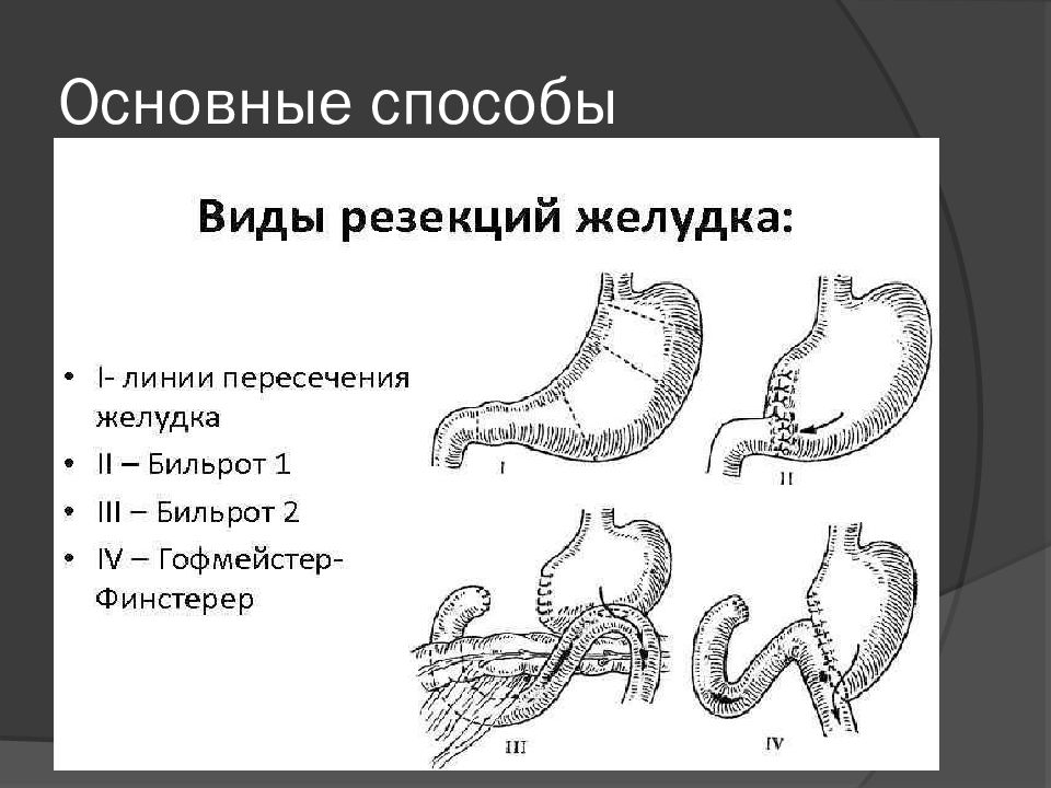 Рак желудка операции презентация