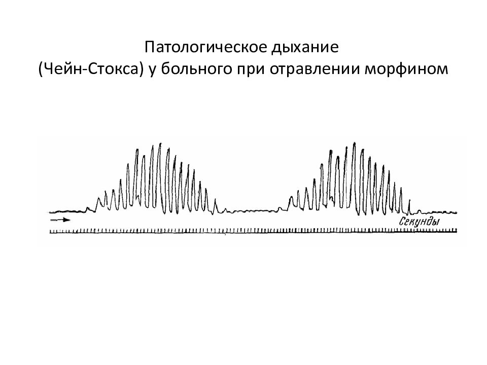 Дыхание чейна стокса что это. Дыхание Чейна Стокса. Патологическое дыхание. Дыхание Чейна-Стокса причины. Пневмограф.