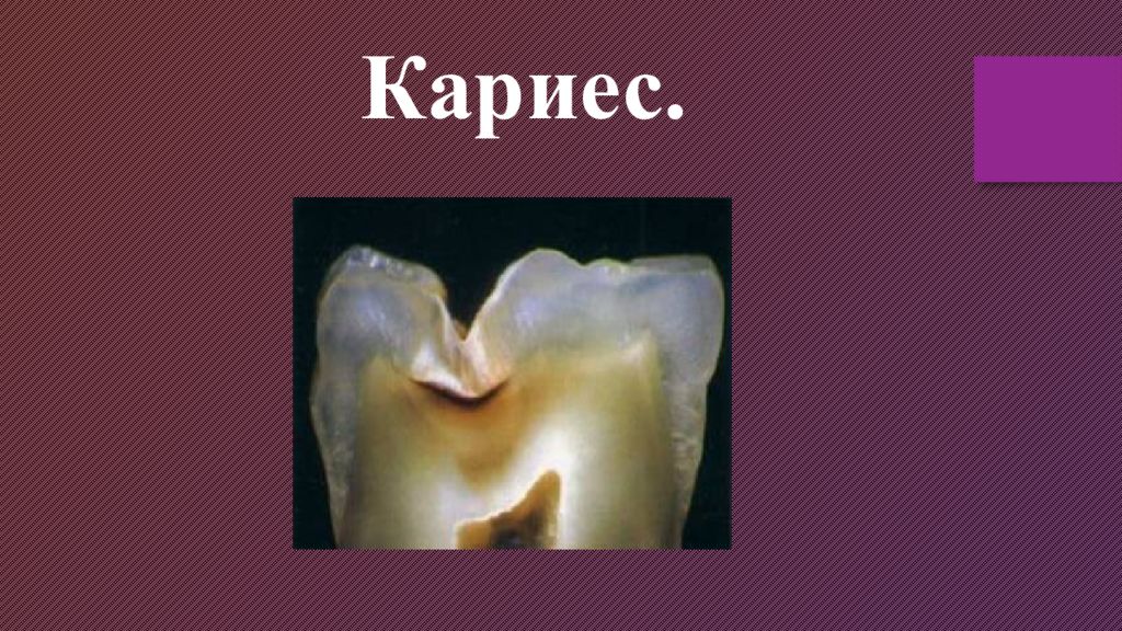 Кариес