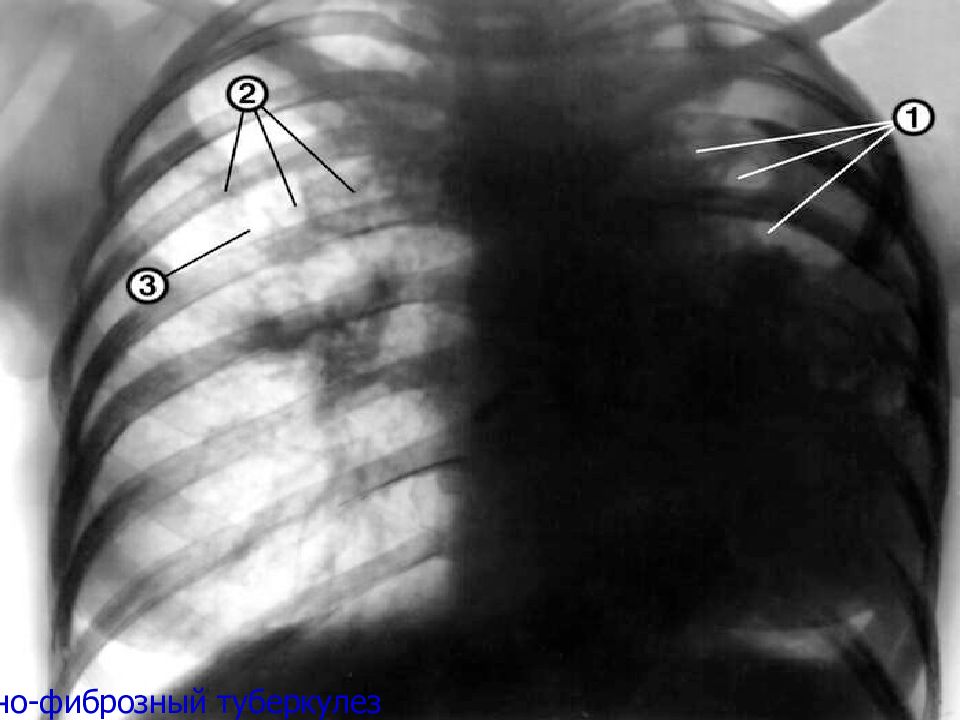 Рентген картина туберкулеза легких