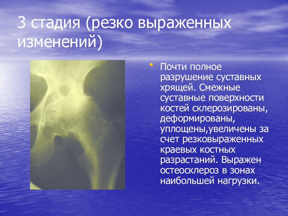 Выраженное изменение. Деструкция суставных поверхностей костей. Остеосклероз костей черепа. Остеосклероз плечевой кости. Локальный остеосклероз бедренной кости.