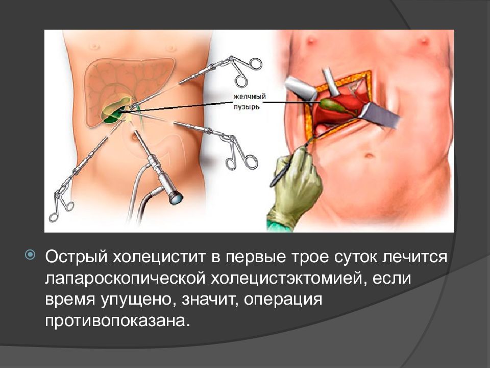 Острый холецистит презентация