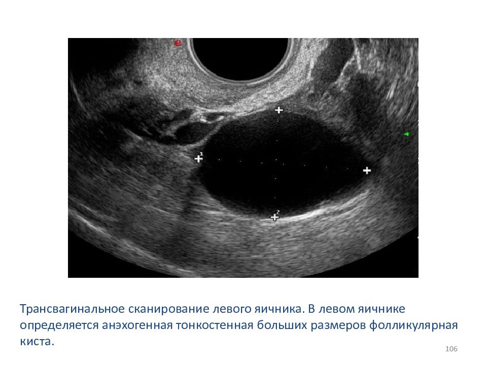 Расширенная полость матки с анэхогенным содержимым. Фолликулярная киста яичника на УЗИ. Многокамерное анэхогенное образование. Многокамерное анэхогенное образование в яичнике. Фолликулярная киста яичника дифференциальный диагноз.