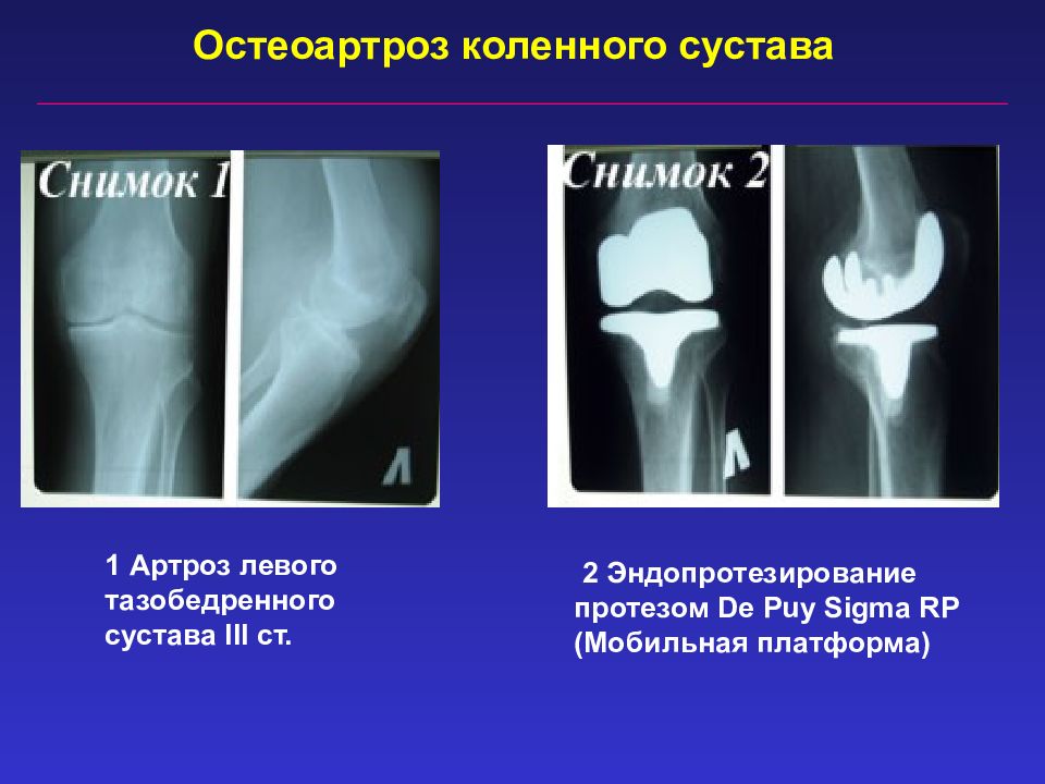 Гонартроз коленного сустава 2. Артроз надколенно-бедренного сустава. Артроз коленный сустава 1ст. Остеоартроза коленного сустава 2ст. Остеоартроз эндопротезирование.