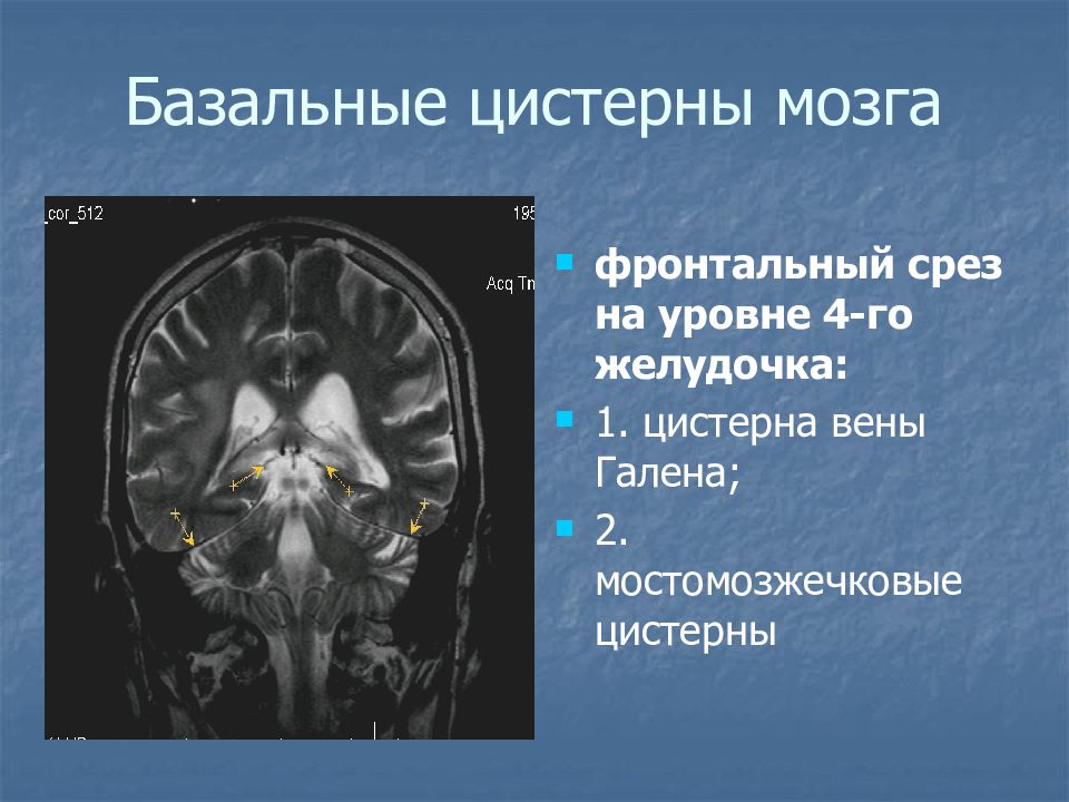 Цистерны мозга расширены