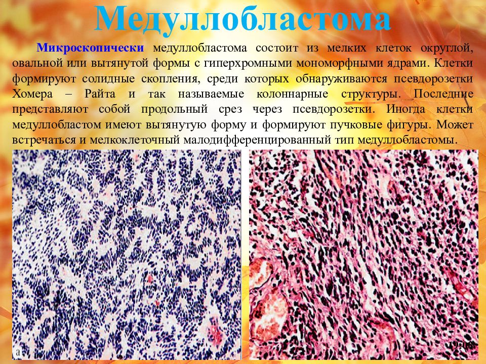 Клетки с гиперхромными ядрами. Медуллобластома клетки. Медуллобластома микропрепарат. Медуллобластома гистология.