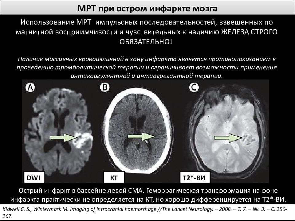 Инфаркт мозга что это. Острый ишемический инсульт мрт. Острый ишемический инсульт кт. Нарушения мозгового кровообращения лучевая диагностика. Плотность ишемического инсульта на кт.