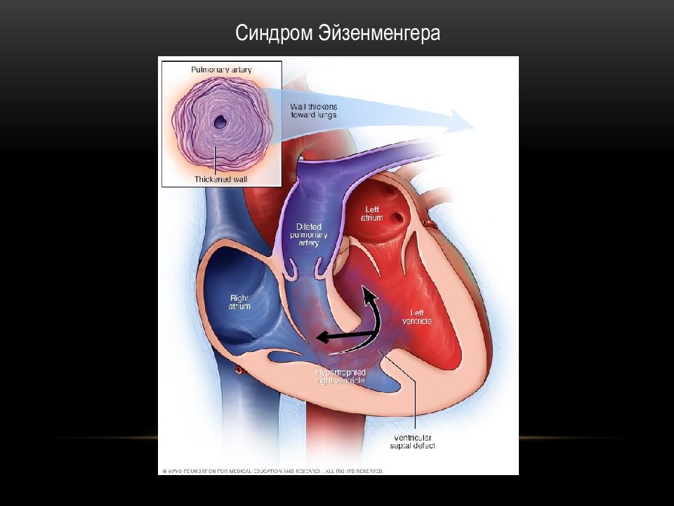 Синдром эйзенменгера презентация