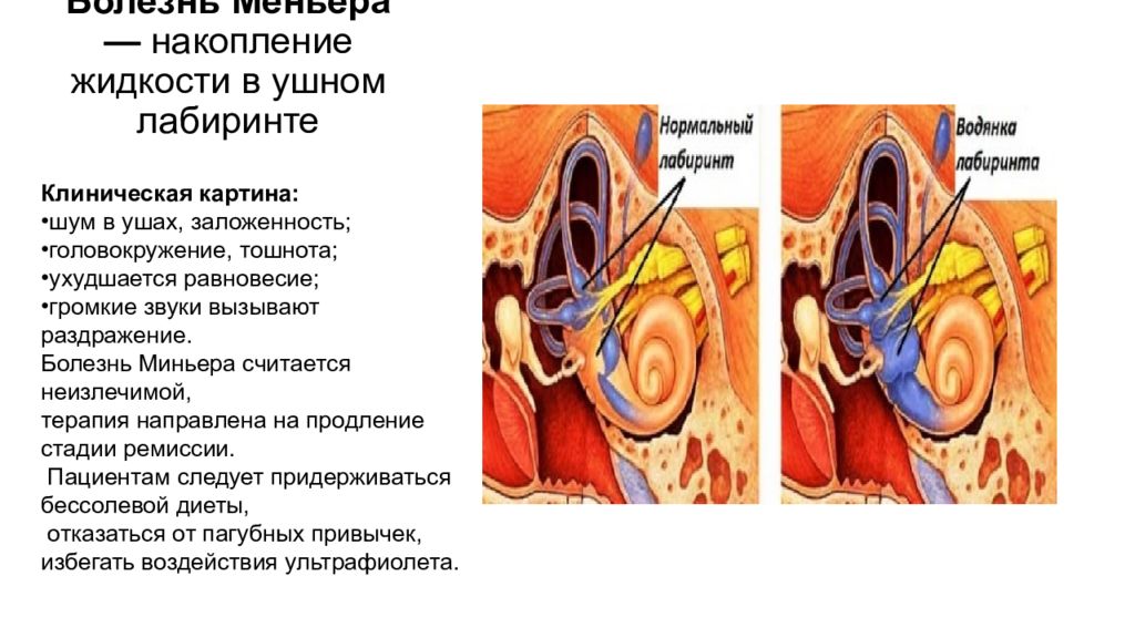 Болезнь меньера клинические рекомендации 2023