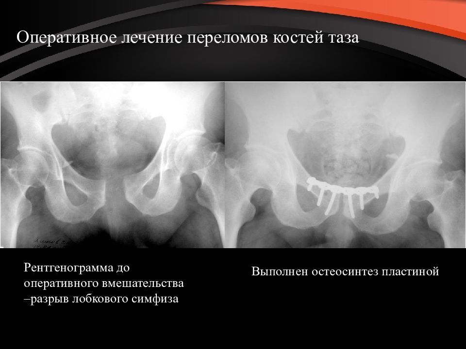 Переломы таза у детей презентация