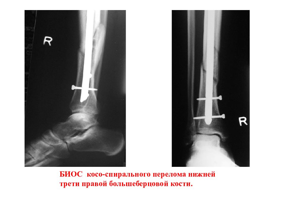Презентация перелом костей голени