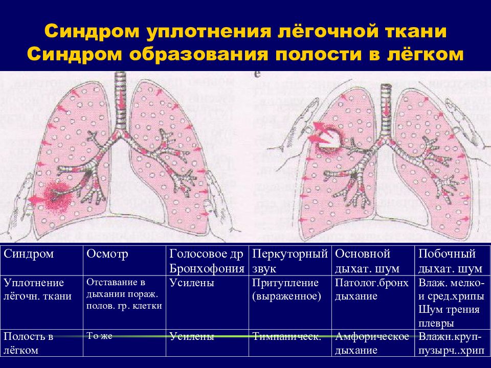 Какая ткань в легких. Уплотнение легочной ткани на рентгене. Синдром уплотнения легочной ткани рентген. Синдром легочного уплотнения рентген. Синдром уплотнения легочной ткани клинические проявления.