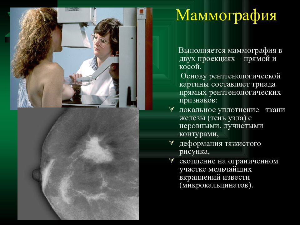 Маммография периодичность. Маммография. Проведение маммографии в двух проекциях. Обзорная маммография в двух проекциях. Маммография это исследование.