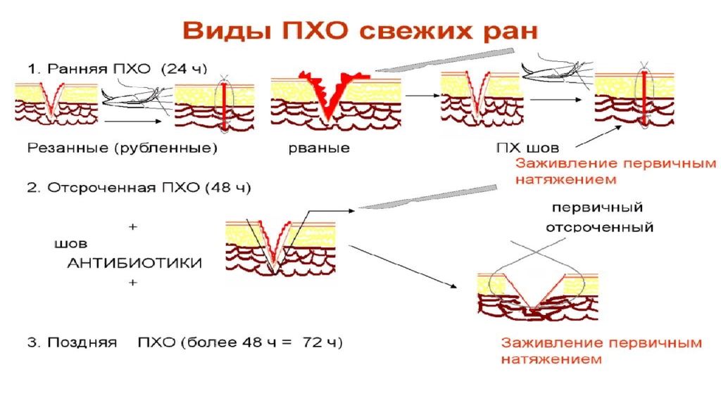 Пхо ран. Первичная хирургическая обработка раны вторичная хирургия. Первичная хир обработка раны. Первичная хирургическая обработка (Пхо). Этапы первичной хирургической обработки РАН.