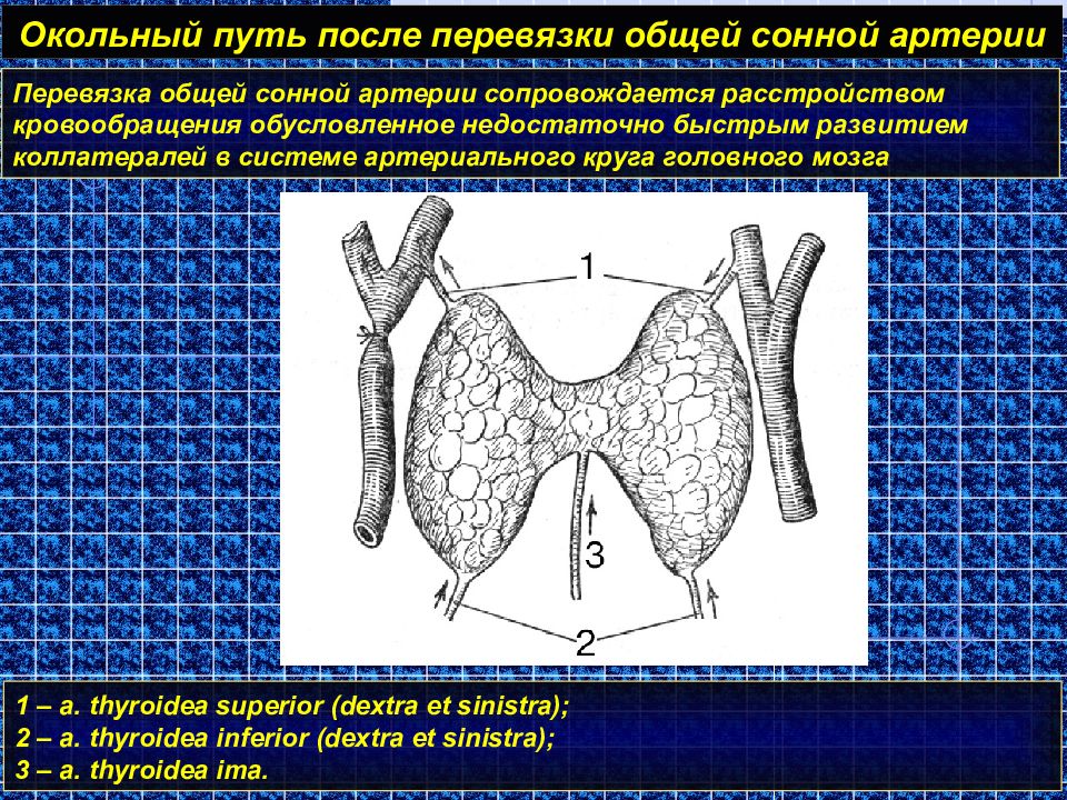 Путь после. Пути Окольного кровотока после перевязки общей сонной артерии. Оперативный доступ к общей сонной артерии. Перевязка общей сонной артерии операция. Пути Окольного кровотока.