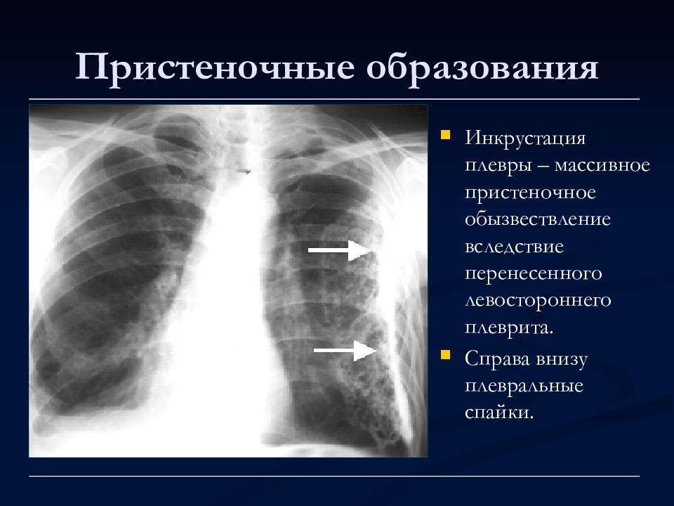 Инкрустация плевры рентгенологическая картина