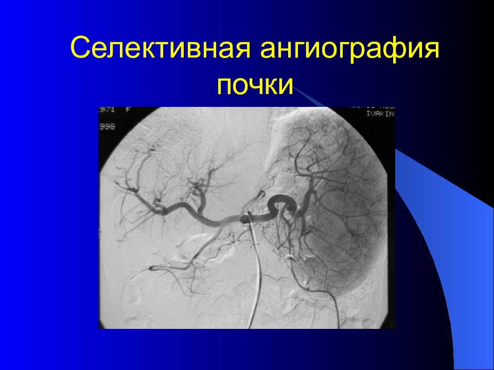 Аневризма брюшной полости. Селективная артериография почек. Селективная рентгеноконтрастная ангиография.. Селективная церебральная ангиография что это. Селективная почечная ангиография.