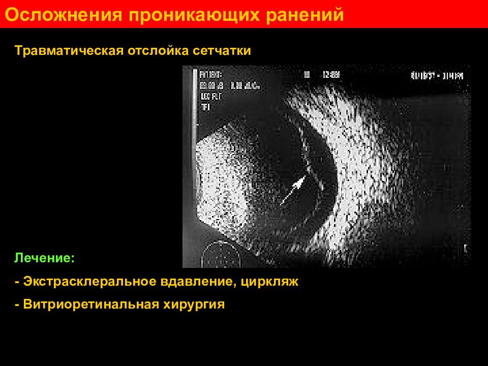 Последствия ранения. Осложнения проникающих ранений глаза. Проникающее ранение глаза осложнения отслойка сетчатки. Травматическое ранение. Ранения от травматического.