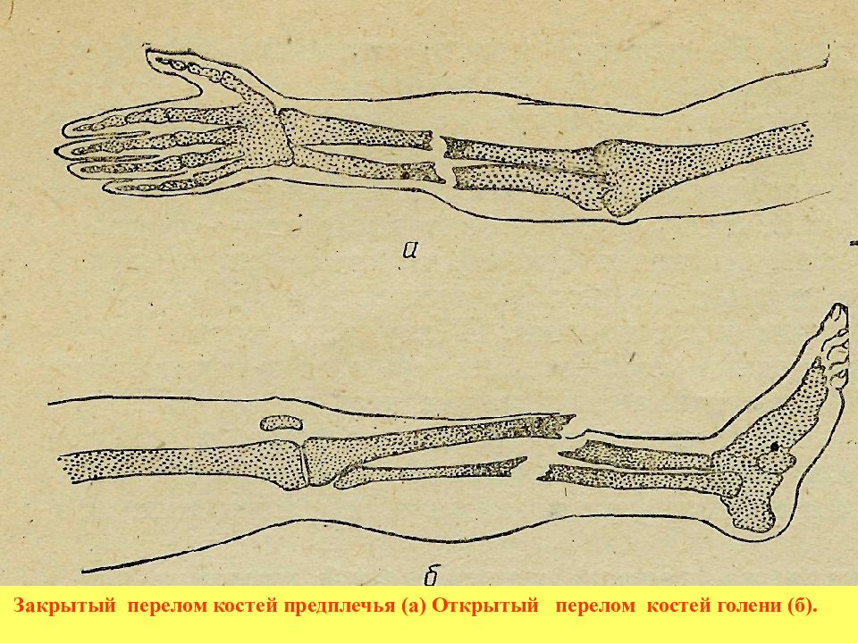 Кости закрыли. Открытый перелом кости. Закрытый перелом костей.