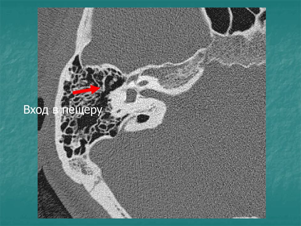 Лабиринт височной кости кт. Анатомия височной кости кт. Кт анатомия улитки височной кости. Гиперостоз височной кости кт.