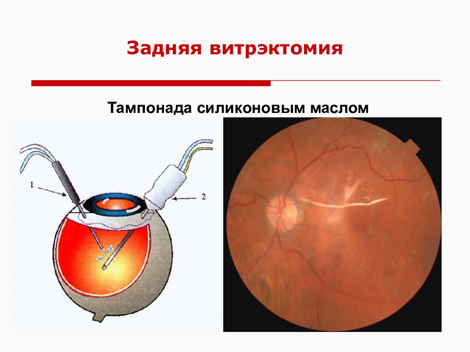 Витрэктомия. Витрэктомия при диабетической ретинопатии. Витрэктомия глаза силиконовая тампонада. Витрэктомия этапы операции.