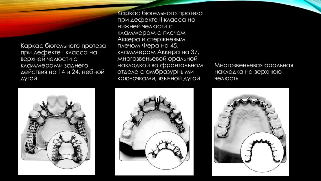 Составные элементы бюгельных протезов презентация