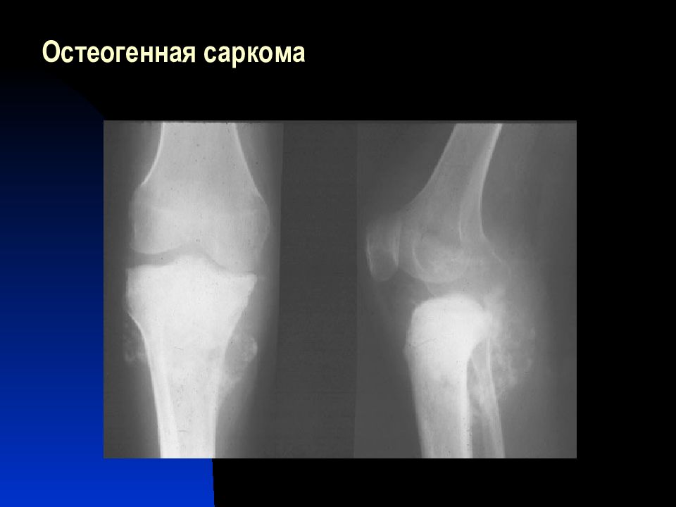 Саркомы костей нмо. Параоссальная остеосаркома. Остеогенная саркома бедренной кости кт. Саркома костей рентген.