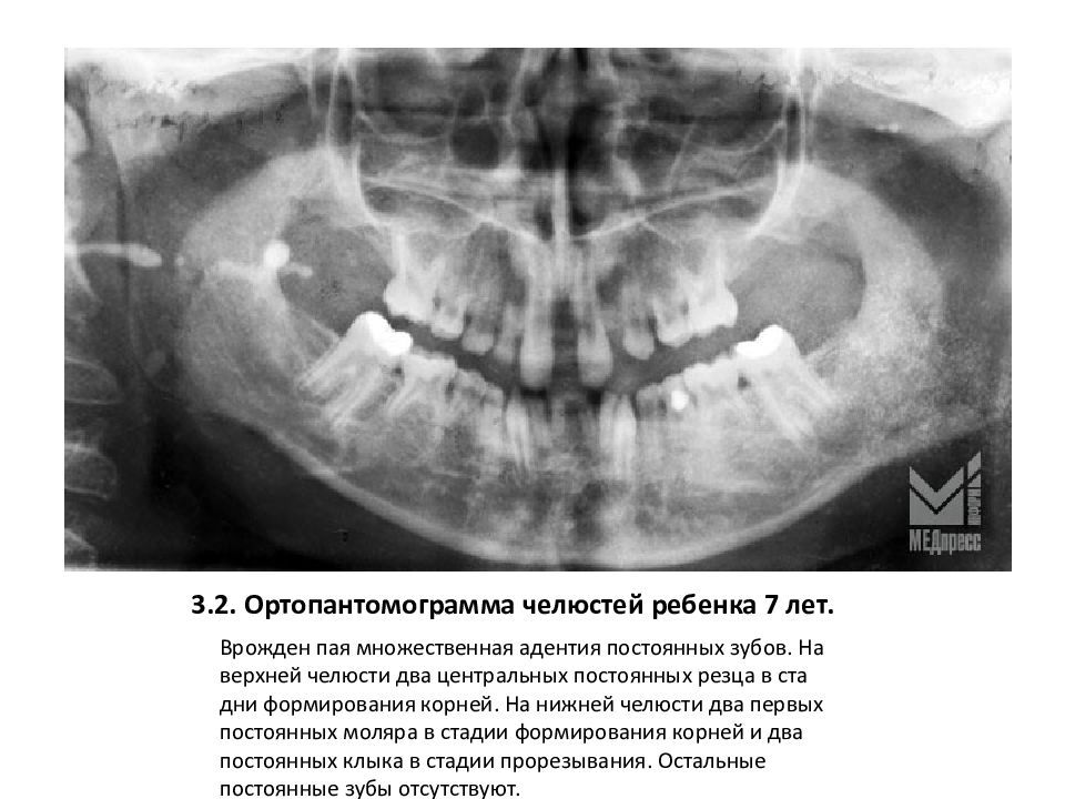 Рентгенологическая картина зубов и их зачатков на различных этапах формирования