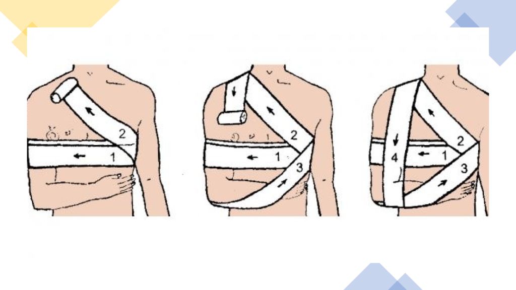 Перевязка ключицы. Повязка Дезо бинтом техника наложения. Наложение повязки Дезо алгоритм. Повязка Дезо на плечо техника наложения. Повязка Дезо алгоритм.