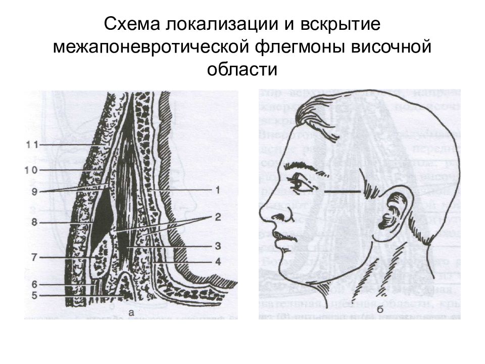 Вскрытие подапоневротической флегмоны