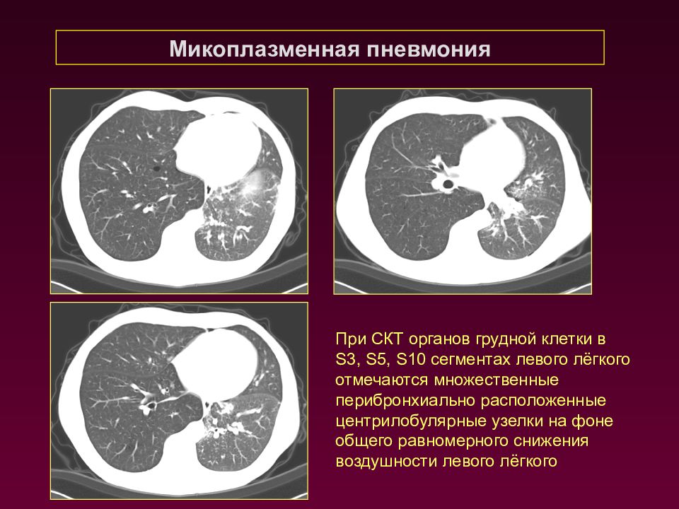 Признаки микоплазменной пневмонии