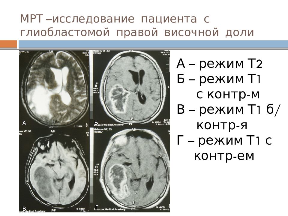 Рак головного мозга презентация