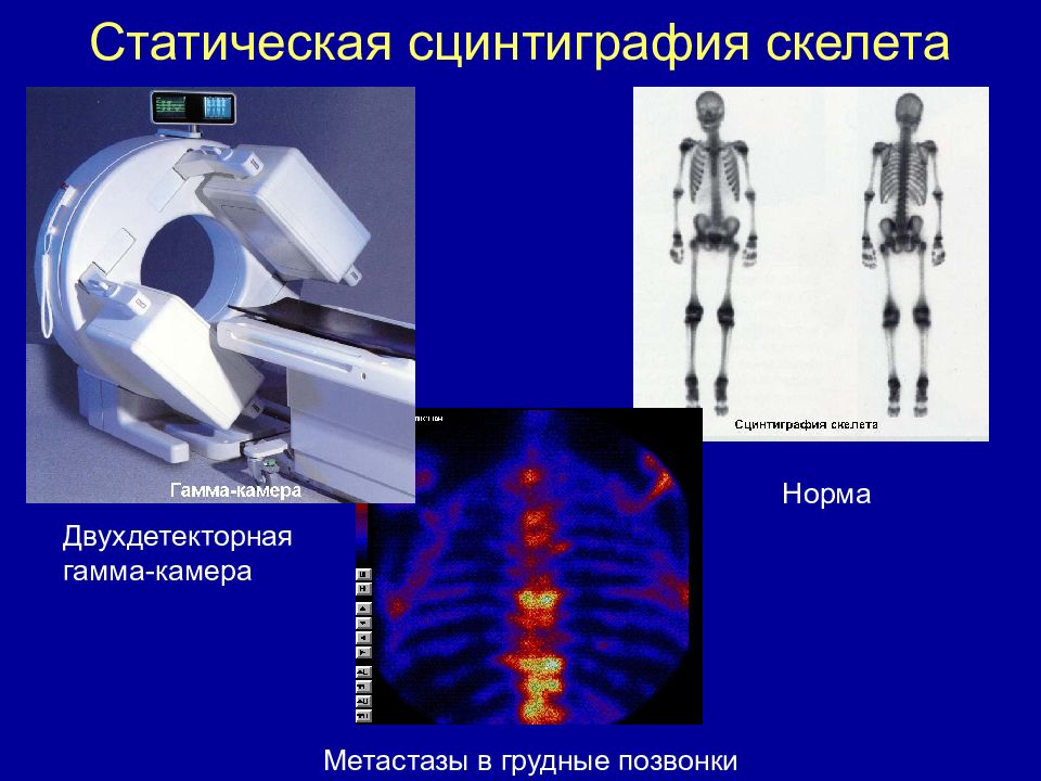 Сцинтиграфия костей скелета. Сцинтиграфия костей гамма камера. Радионуклидная сцинтиграфия костей. Радионуклидная диагностика остеосцинтиграфия. Остеосцинтиграфия аппарат для исследования костей.