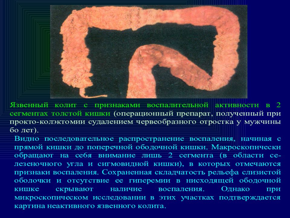 Рентгенодиагностика заболеваний толстой кишки. Воспалительный процесс толстом кишечнике. Заболевание тонкой кишки название. Воспалительные заболевания толстой кишки. Основные симптомы заболевания кишечника.