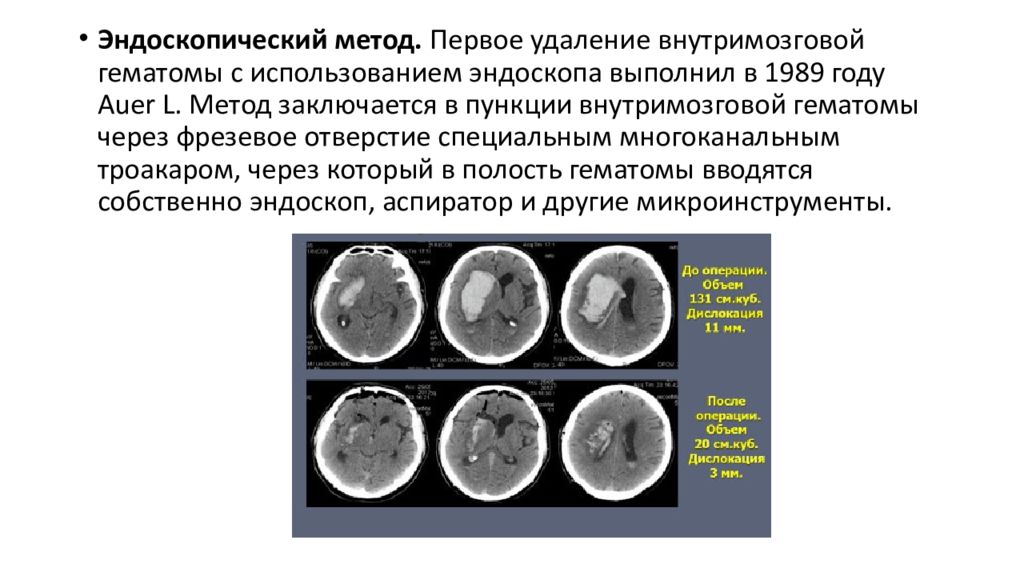 Геморрагический инсульт неотложная терапия. Операция при геморрагическом инсульте. Геморрагический инсульт неотложная терапия. Неотложная терапия при ишемическим инсульте. Терапия при геморрагическом инсульте.