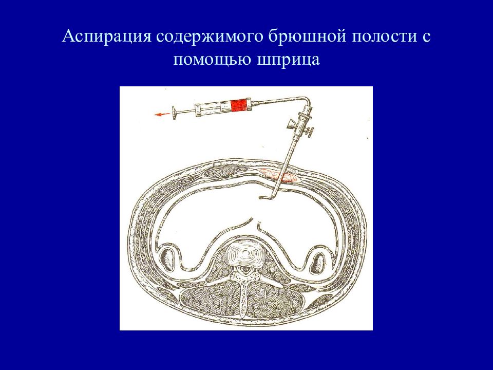 Повреждение паренхиматозных органов. Аспирация содержимого. Введение газов в брюшную полость. Шприцы для брюшной полости.