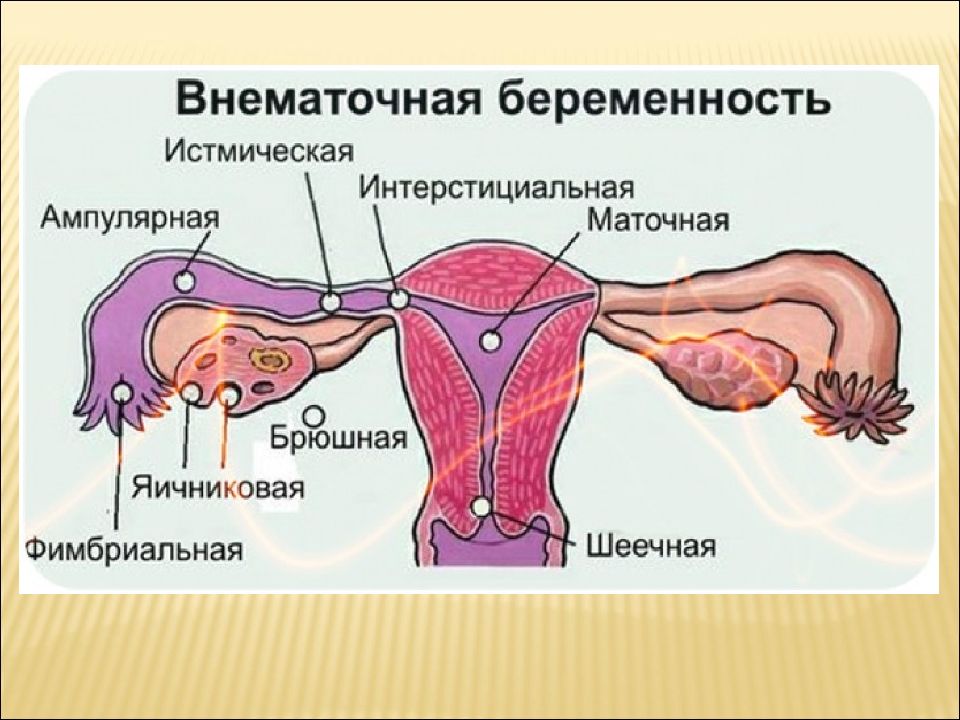 Брюшная беременность. Внематочная беременность Трубная беременность. Интерстициальная внематочная беременность. Внематочная беременность схема. Внематочная беременность Трубная ампулярную.