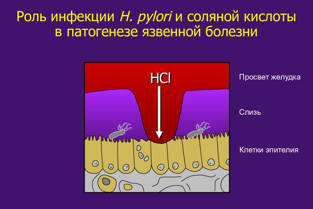 Этиология и патогенез язвенной болезни желудка презентация