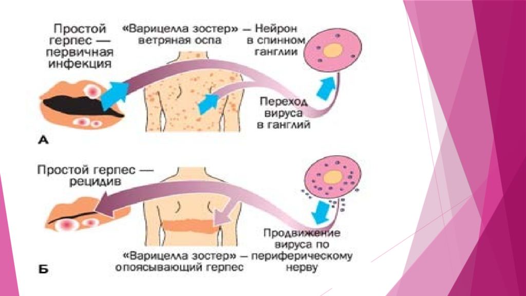 Герпес схема. Опоясывающий герпес и ветряная оспа патогенез. Возбудитель опоясывающего герпеса. Опоясывающий герпес патогенез. Герпес Варицелла зостер.