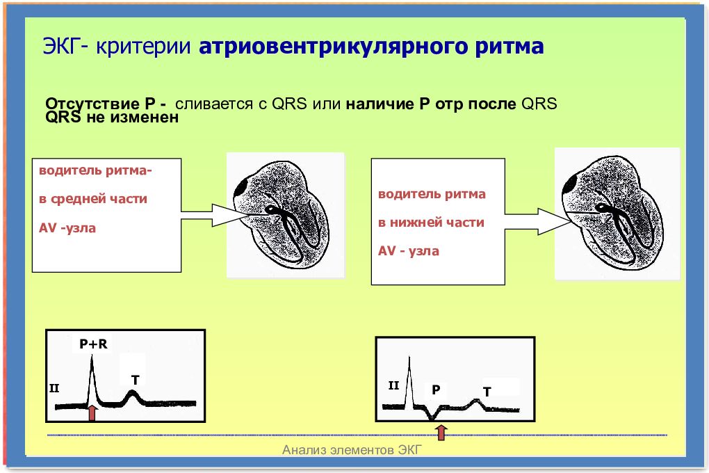 Ритм проводимости. QRS-анализ. Водитель ритма матки. Водитель ритма АВ узел ЭКГ. ЭКГ водителя ритма 78.